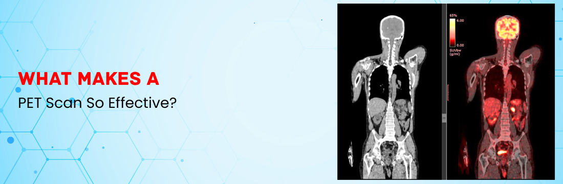 What Makes a PET Scan So Effective?